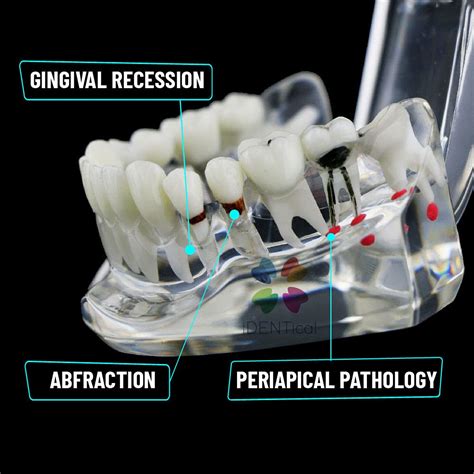 Buy iDENTical Dental All In One Study Model, Feature - Dental implants ...