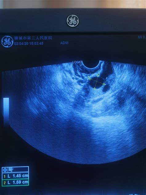 超声下的卵泡监测-健康科普-武汉市第三医院|武汉大学同仁医院
