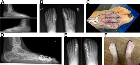 The First Metatarsophalangeal Joint - Clinics in Podiatric Medicine and Surgery