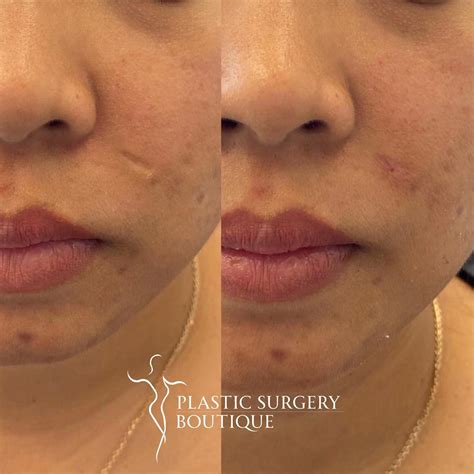 Scar Revision Procedure 的图像结果