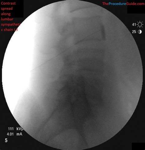 Fluoroscopy Injection 的图像结果