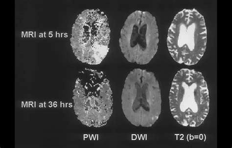 Alteplase May Improve Outcomes When Given 4.5-24 Hours After Stroke in ...