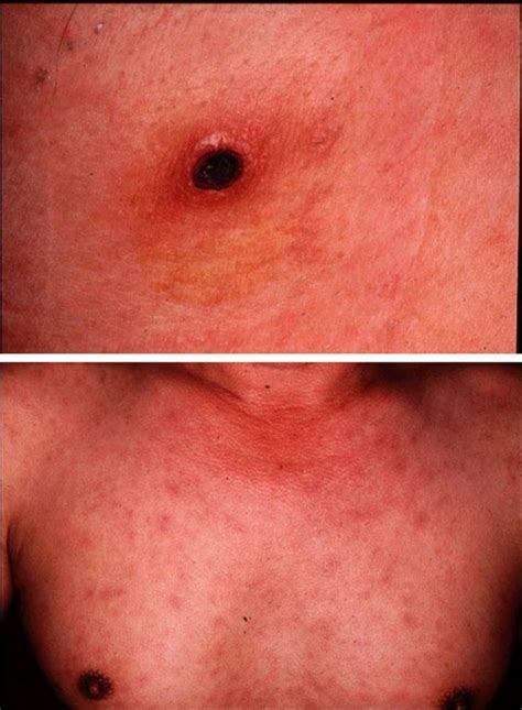 Image: Scrub Typhus - MSD Manual Professional Edition