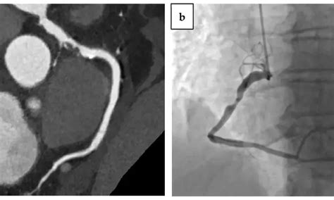 Coronary artery calcium evaluation with chest CT strongly linked to ...