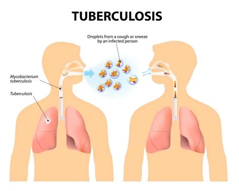 Tuberculosis - Cause, Symptoms, Diagnosis, Treatment
