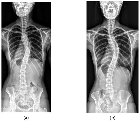 Curve Progression in Adolescent Idiopathic Scoliosis with Cobb Angles ...