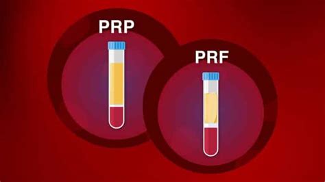Image result for PRF Testing