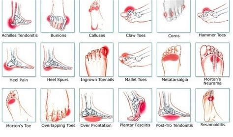 Plantar Fasciitis Boot | Relive your SEVERE and CHRONIC Pain QUICKLY