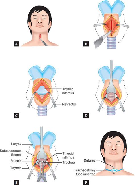 Image result for Trach Procedure