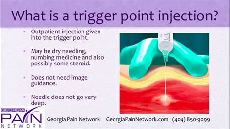 Trigger Point Injections 的图像结果