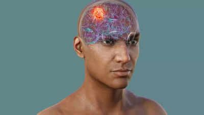 Brain Cancer: Doctor shares 5 early warning signs of Glioblastoma, a ...