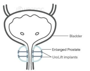 Image result for Problems After UroLift