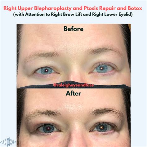 Raleigh Eye and Face Plastic Surgery - Raleigh Eye and Face Plastic Surgery - Serving Raleigh ...