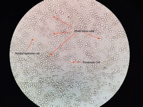 Desquamative Inflammatory Vaginitis or DIV