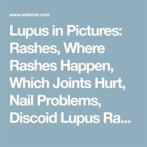 lupus joints