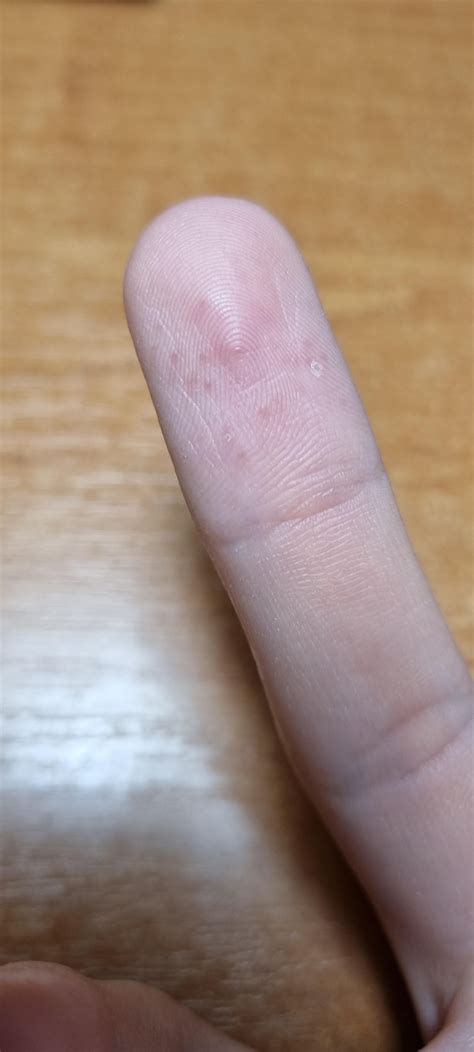 Small bumps appearing on my fingers, neither itchy nor painful, unless I press on that area ...