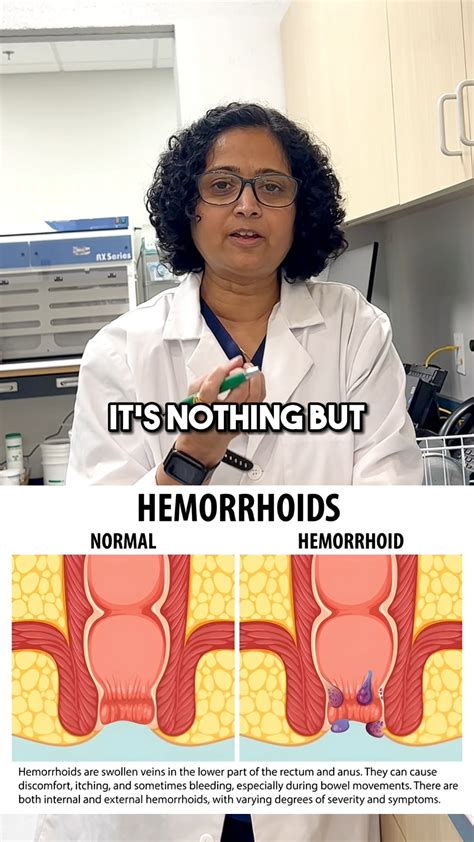 How to treat and prevent hemorrhoids doctor explains piles hemorrhoids ...