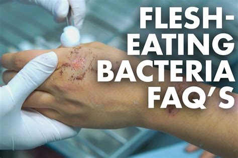 Flesh Eating Bacteria Beginning Stages