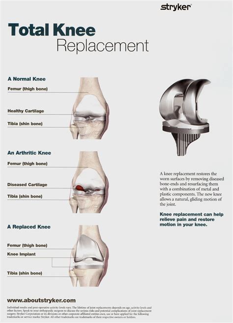 Total Knee Replacement with Stryker Navigation or OMNI Robotic-Assisted ...