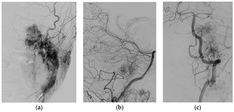 Disease and Treatment-Related Sequelae in Patients with Complex ...