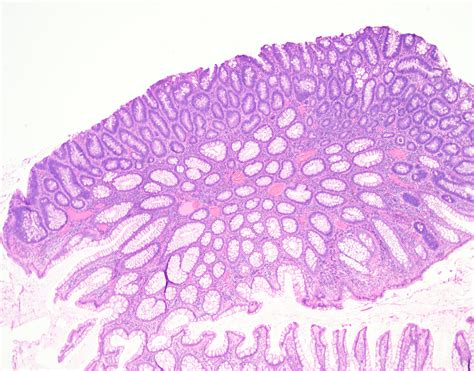 Polyps In Colon Tubular Adenoma at Daniel Isaac blog
