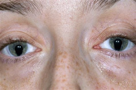 Image:Coloboma-MSD Manual Consumer Version