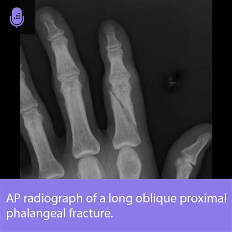 Proximal Phalanx Fracture