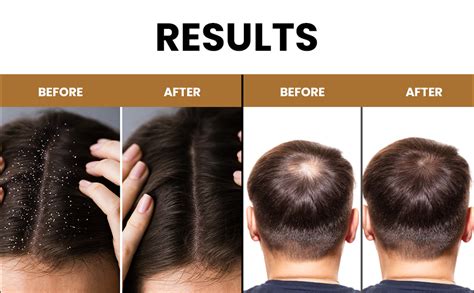 Buy myUpchar Ayurveda KeshArt Bhringraj Hair Anti-Dandruff Shampoo ...