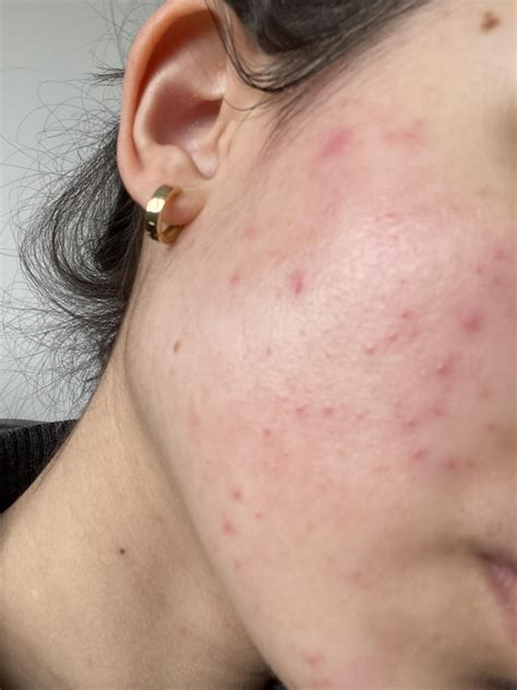 HELP! I ruined my almost perfect skin! Damaged skin barrier? Acne ...