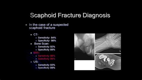 Scaphoid Fracture Test 的图像结果