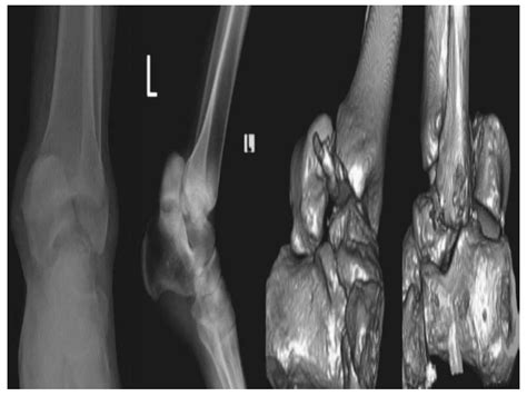 Simultaneous Bilateral Fracture
