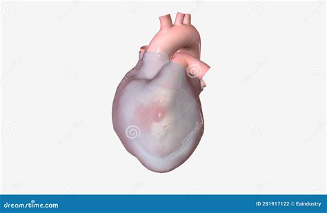 Pericardial Effusion is a Cardiac Condition Characterized by Fluid Buildup Outside the Heart ...