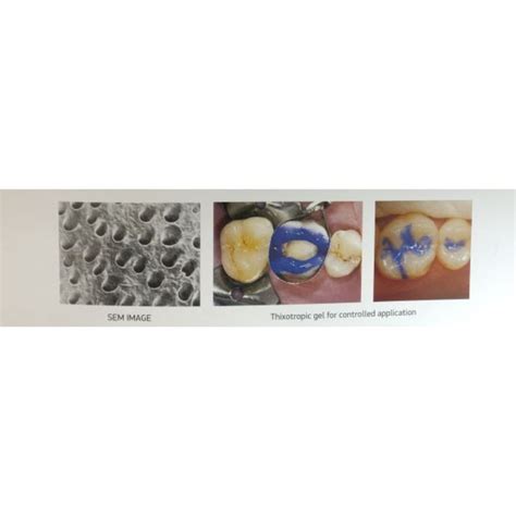 Safe Endo Smart Etch Etching – Dentalmantraa