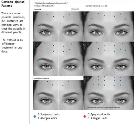 Image result for Botox Injection Patterns