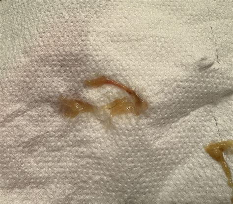 More bloody mucus on stool : r/poop