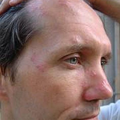 A mild shingles rash on the face. | Rash on face, Natural remedies, Shingles on face