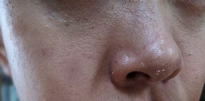 Clogged Pores - Causes, Tips and Natural Remedies