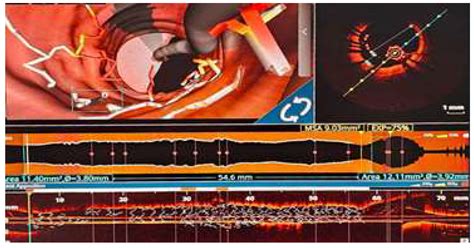 Exploring the Value of Optical Coherence Tomography Parameters in ...