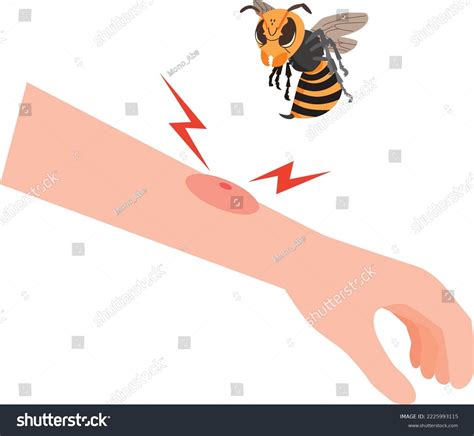 Swollen Hand Stung By Bee Stock Vector (Royalty Free) 2225993115 | Shutterstock