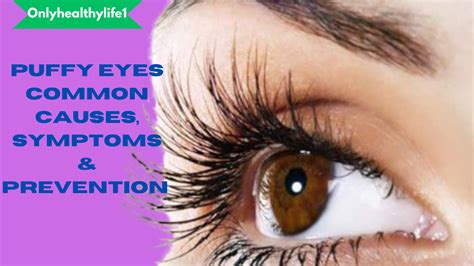 Don't worry about puffy eyes:Common causes, symptoms & how to prevent it - Onlyhealthylife1