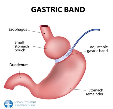 Lap Band Surgery: Complete Guide of Gastric Banding - Medical Tourism Resource Guide