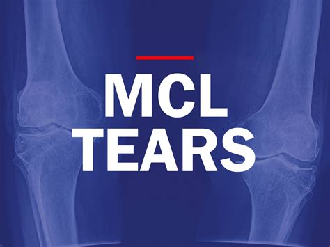 Mri Knee Mcl Tear