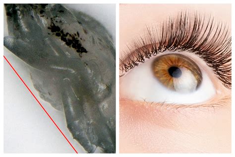Eyelash Mites Blepharitis NHS