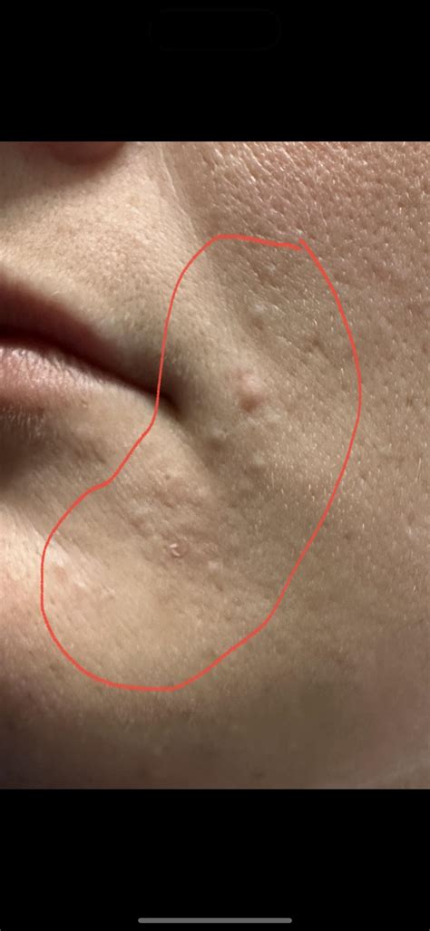 Pimple Under Skin