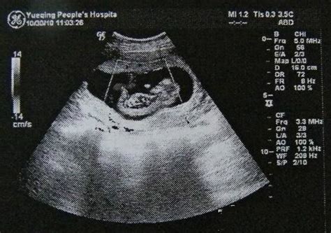 怀孕1个月b超照片可以看出胎儿长什么样子吗？ - 妈妈育儿网