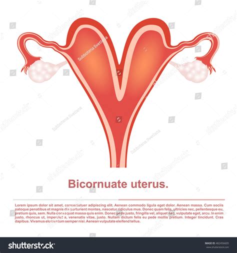 Illustration Female Reproductive Organ Bicornuate Uterus Stock Vector ...