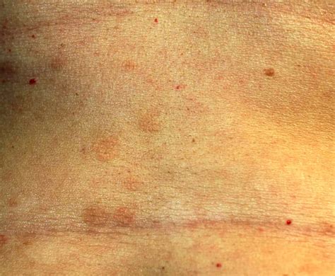 Red Spots On Skin Causes : Red Spots On Skin: Causes, Images And Treatment – DECWEE
