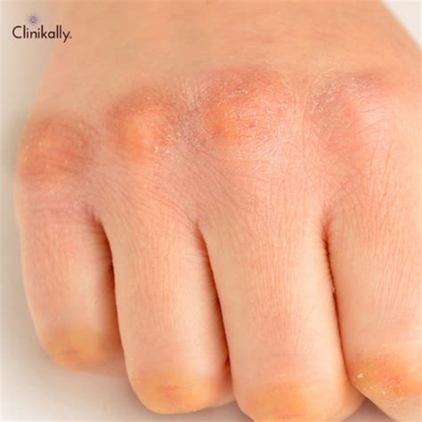 How to Treat Dark Knuckles Effectively | Clinikally