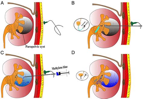 Kuvatulokset haulle parapelvic cyst kidney