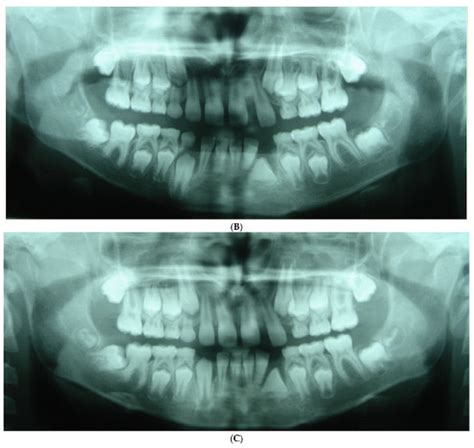 Mandibular Second Molar Impaction-Part II: Etiology and Role of the ...